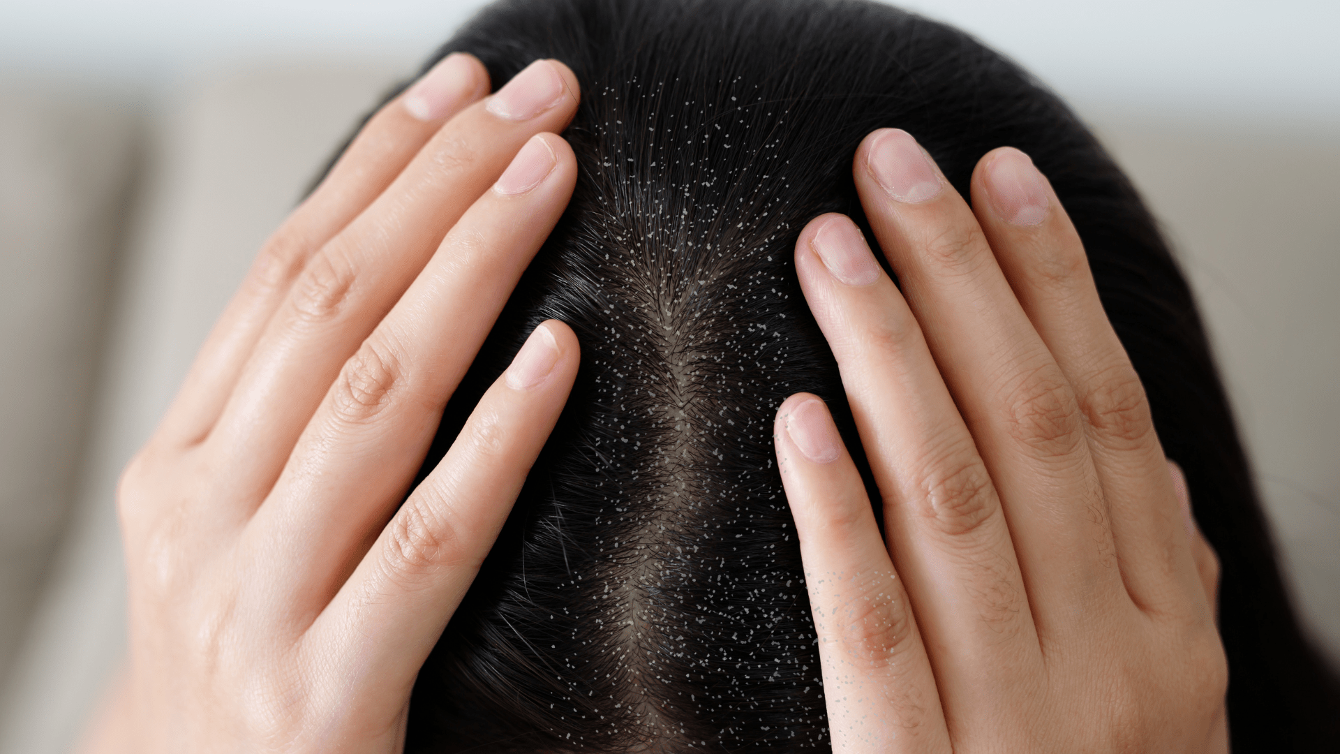 Say goodbye to dandruff