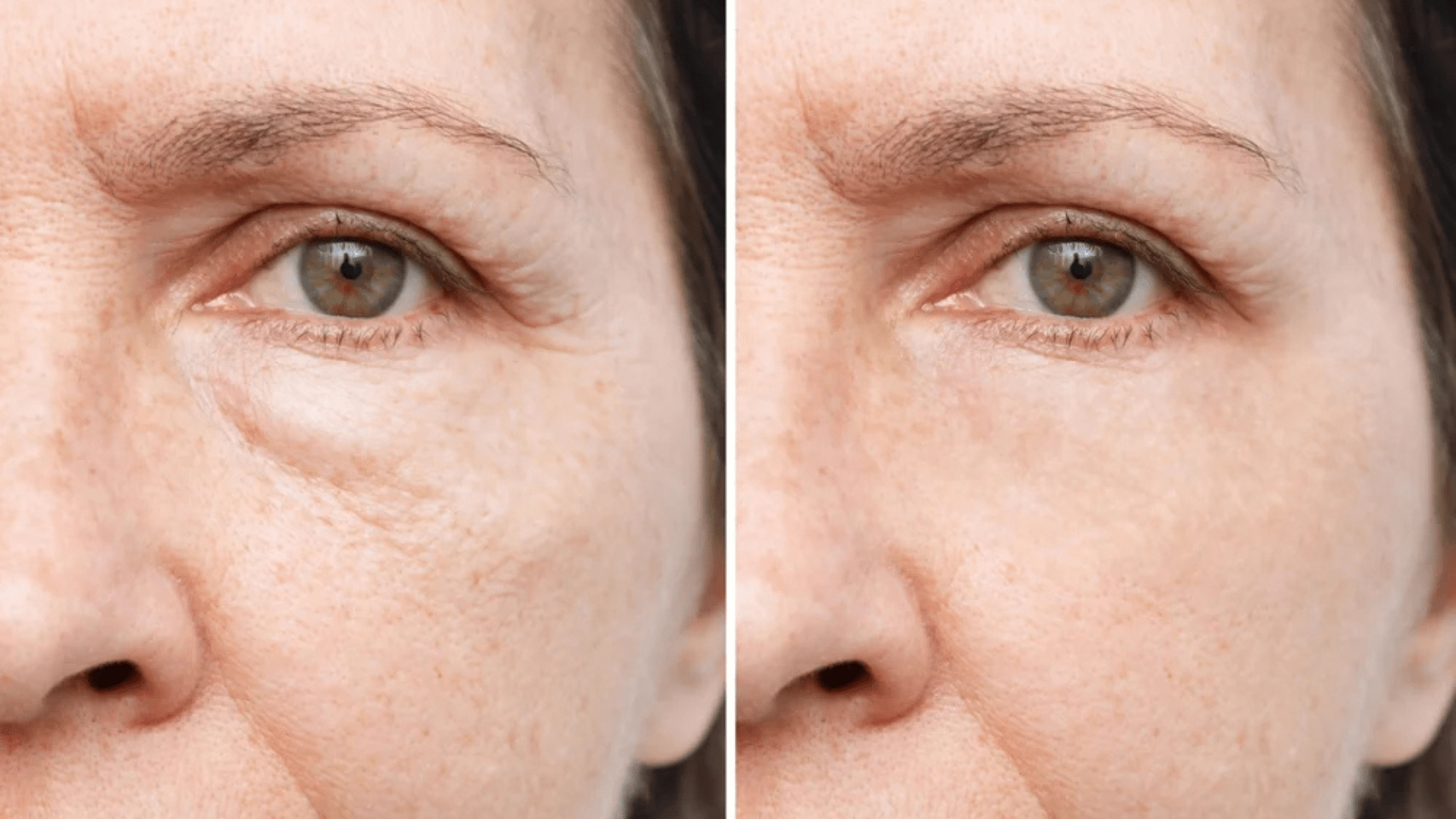 How to Get Rid of Dark Circles and Puffy Eyes Naturally